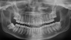 Панорамный снимок зубов. Cтоматологическая клиника СитиДентаМед в Жодино