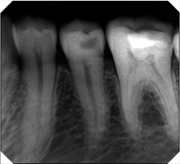 Рентген зуба. Cтоматологическая клиника СитиДентаМед в Жодино
