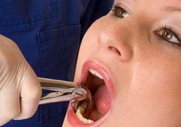 Удаление зубов. Cтоматологическая клиника СитиДентаМед в Жодино
