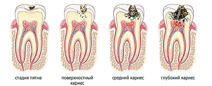 Этапы лечения кариеса