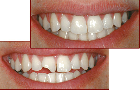 Восстановление зубов. Cтоматологическая клиника СитиДентаМед в Жодино
